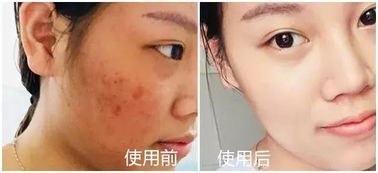 皮膚科醫生力薦 醫用面膜如何一招擺脫敏感肌困擾？